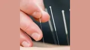 AQure Acupuncture