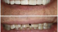 Porcelain Veneers