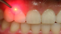 Dental Laser Treatment
