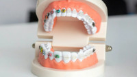 Braces