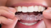 Invisalign