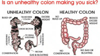 Colon Hydrotherapy