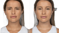 Jeuveau Treatments